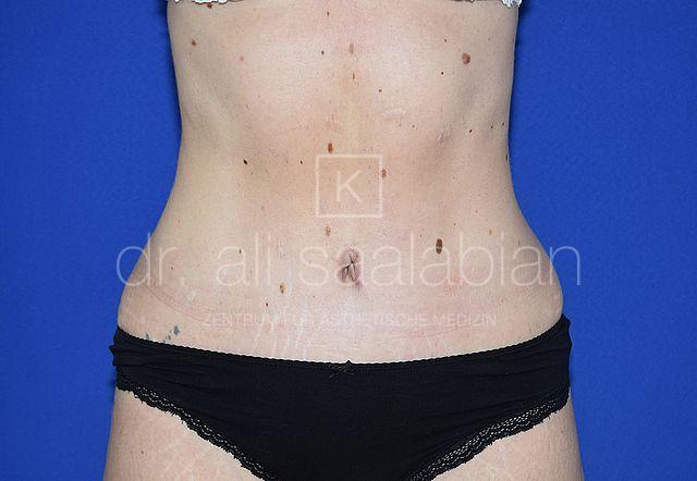 Bauchdeckenstraffung, 33 Vorher Nachher
