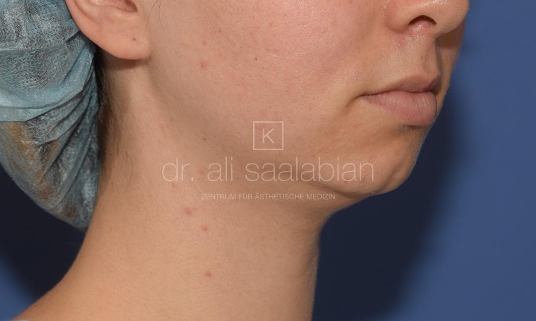 Fettabsaugung, 23 Vorher Nachher