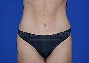 Bauchdeckenstraffung, 38 Vorher Nachher