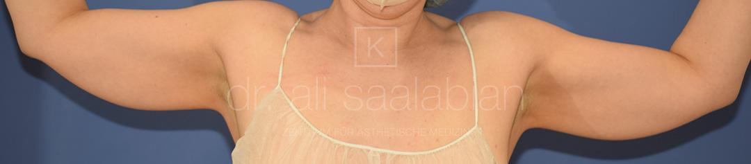 Fettabsaugung, 43 Vorher Nachher
