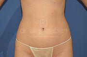 Fettabsaugung, 23 Vorher Nachher