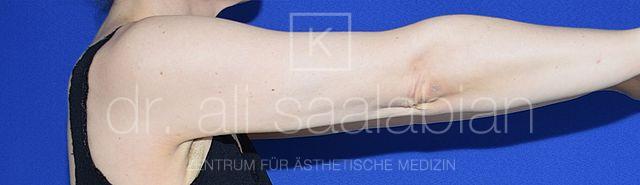 Fettabsaugung, 43 Vorher Nachher