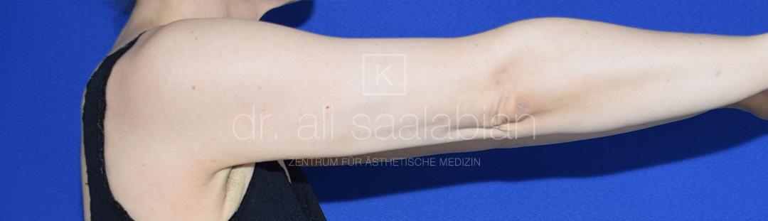 Fettabsaugung, 43 Vorher Nachher