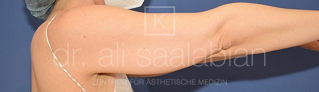 Fettabsaugung, 43 Vorher Nachher