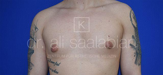 Fettabsaugung, 26 Vorher Nachher