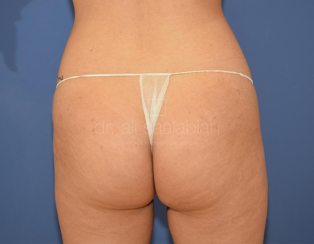 Fettabsaugung, 23 Vorher Nachher