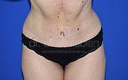 Bauchdeckenstraffung, 33 Vorher Nachher