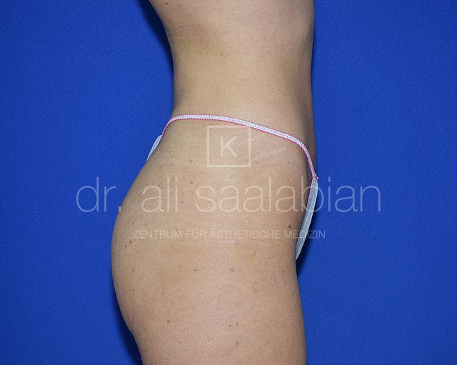 Fettabsaugung, 23 Vorher Nachher