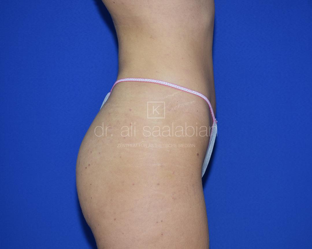 Fettabsaugung, 23 Vorher Nachher