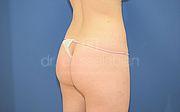 Body Contouring, 20 Vorher Nachher