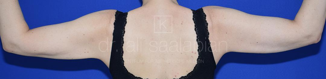 Fettabsaugung, 43 Vorher Nachher