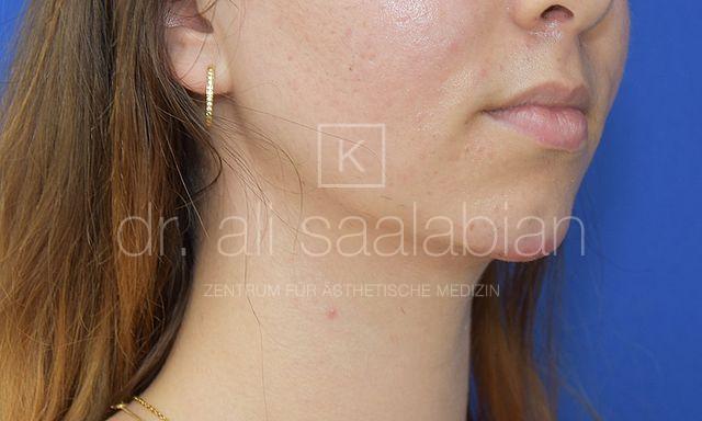 Fettabsaugung, 23 Vorher Nachher