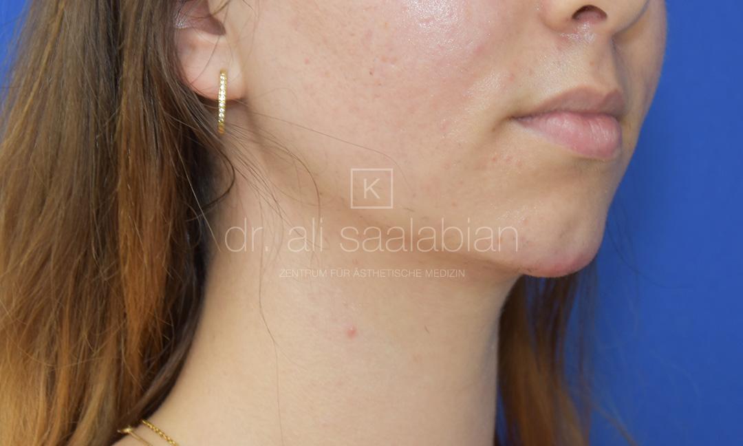 Fettabsaugung, 23 Vorher Nachher