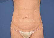 Bauchdeckenstraffung, 38 Vorher Nachher