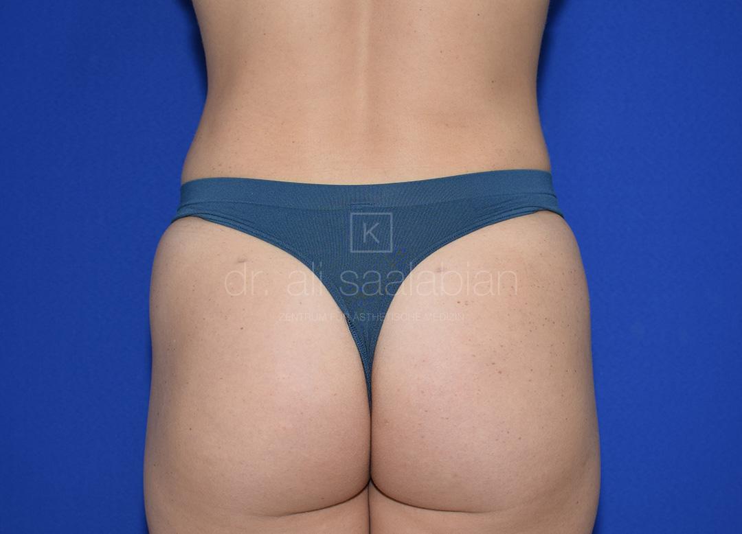 Fettabsaugung, 22 Vorher Nachher