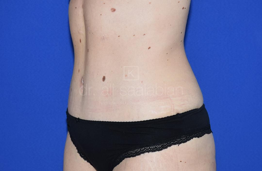 Bauchdeckenstraffung, 33 Vorher Nachher