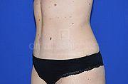 Bauchdeckenstraffung, 33 Vorher Nachher