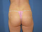 Fettabsaugung, 26 Vorher Nachher