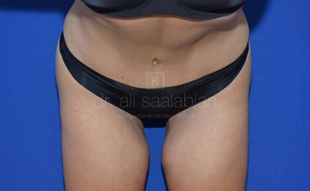 Bauchdeckenstraffung, 38 Vorher Nachher