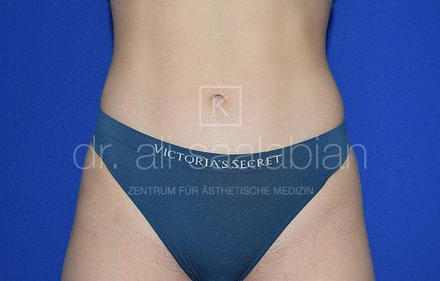 Fettabsaugung, 22 Vorher Nachher