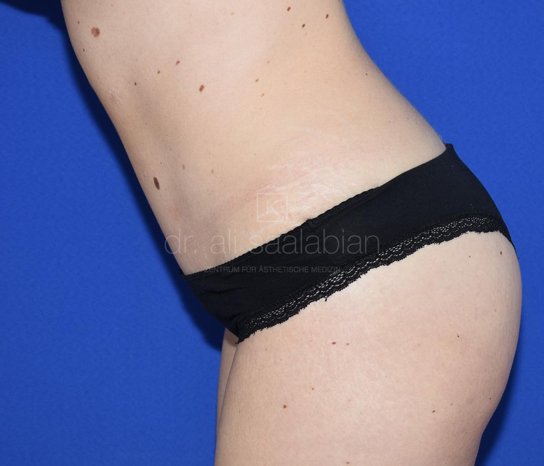 Bauchdeckenstraffung, 33 Vorher Nachher