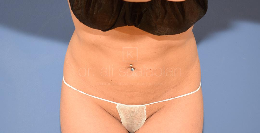 Fettabsaugung, 38 Vorher Nachher