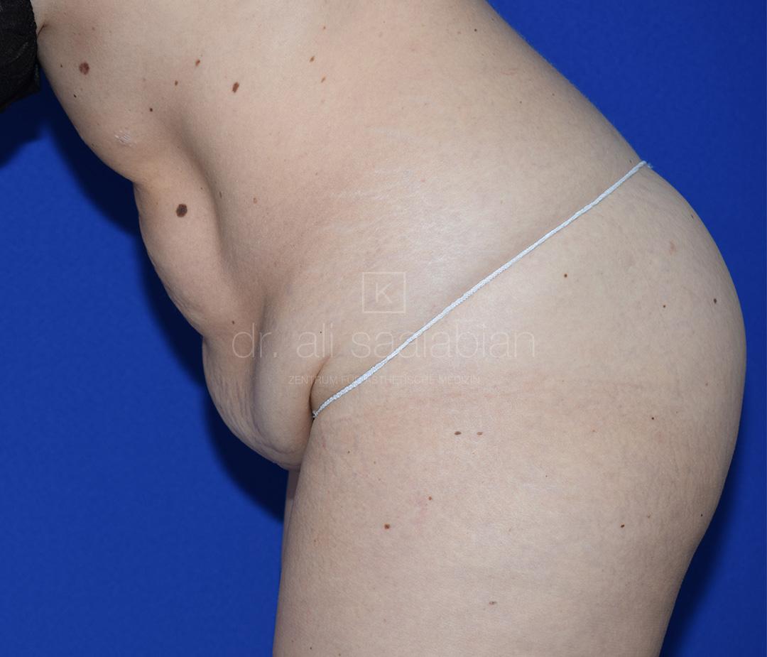 Bauchdeckenstraffung, 33 Vorher Nachher