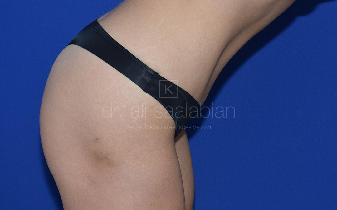 Bauchdeckenstraffung, 38 Vorher Nachher