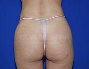 Fettabsaugung, 23 Vorher Nachher