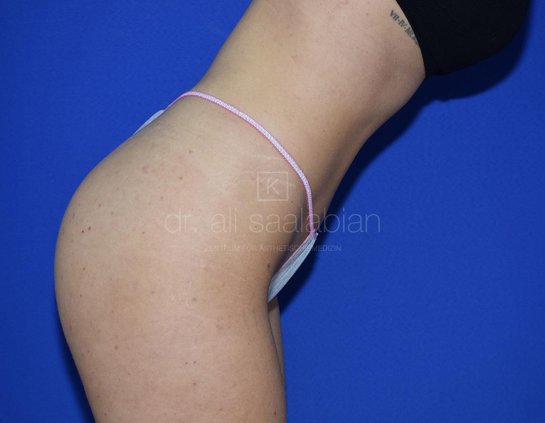 Fettabsaugung, 23 Vorher Nachher